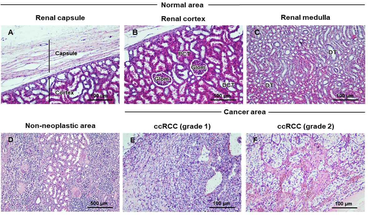 Histological features of normal, non-neoplastic, and cancer areas of nephrectomy specimens of patients with ccRCC. 